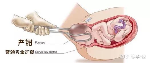 我的宝宝 被产钳夹死了 知乎