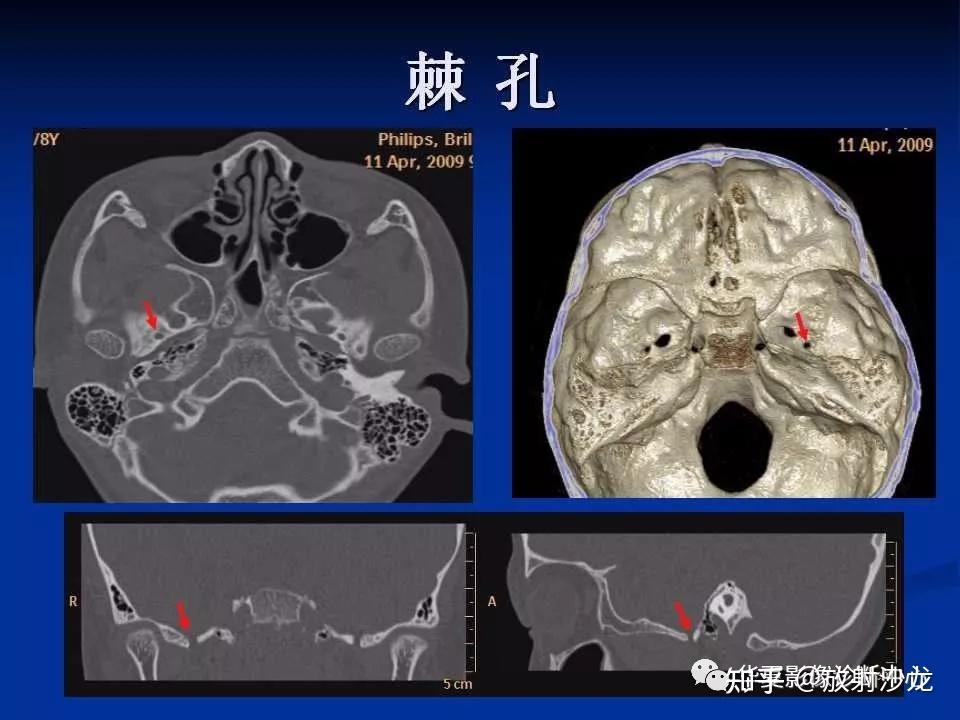 实用、详细的颅底各孔道影像解剖! - 知乎