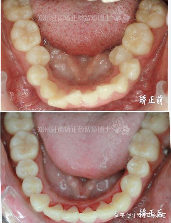 7415治療結果:牙齒排齊,咬合恢復正常,牙弓形態匹配,笑起來時頰廊