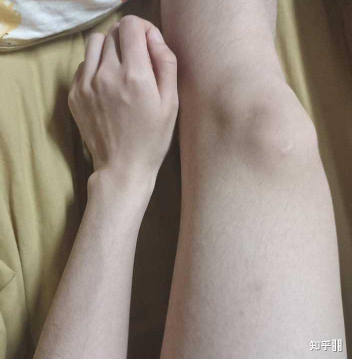 腿太粗胳膊又太细是什么原因
