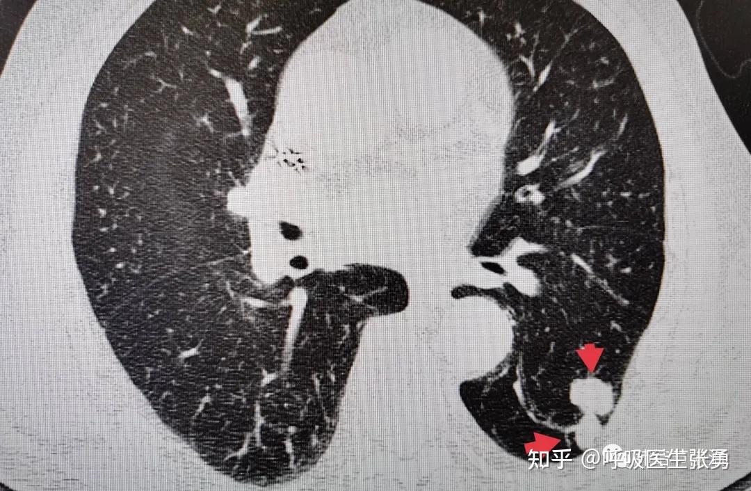 肺癌的肺泡間轉移stas對肺結節臨床處理的指導意義