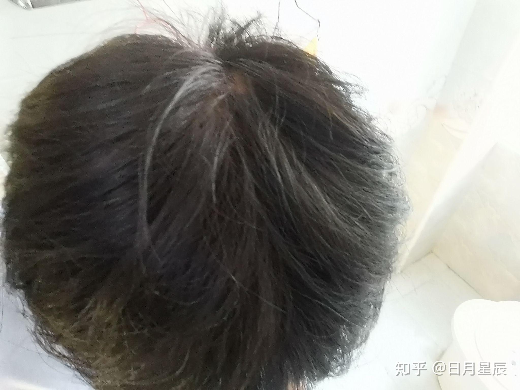 男生20岁 头发细软每次洗澡掉十根左右头发 算脱发吗?