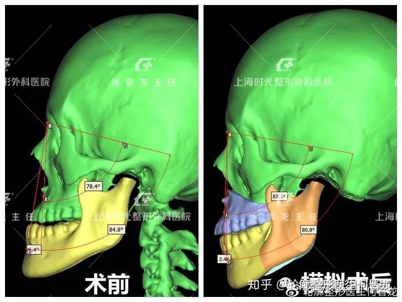 做正颌手术是怎样的体验?