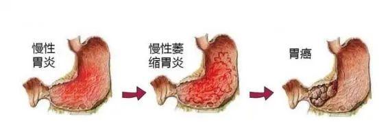 慢性胃炎与消化性溃疡有何区别?不注意警惕癌变! - 知乎