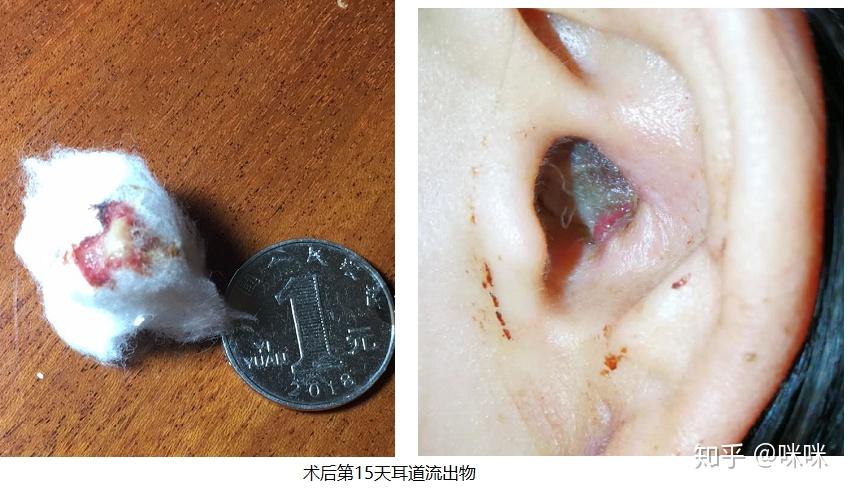 耳膜穿孔手术图片图片