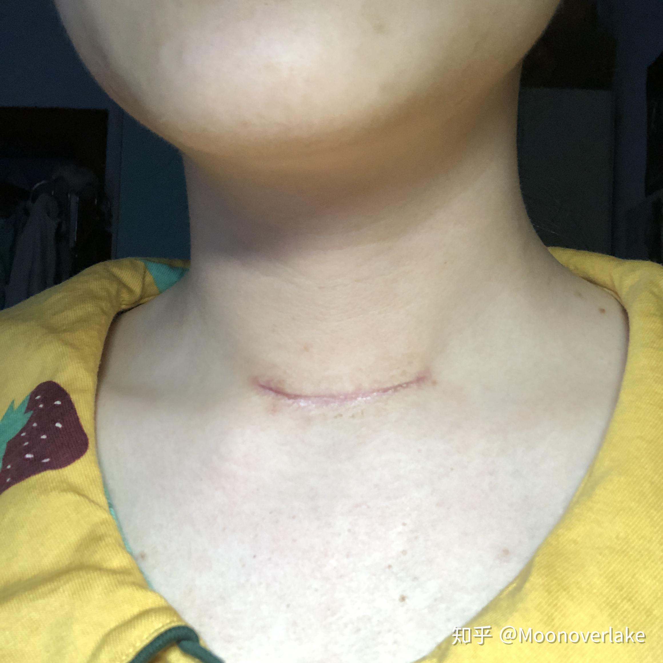 甲状腺切除(半切)全记录