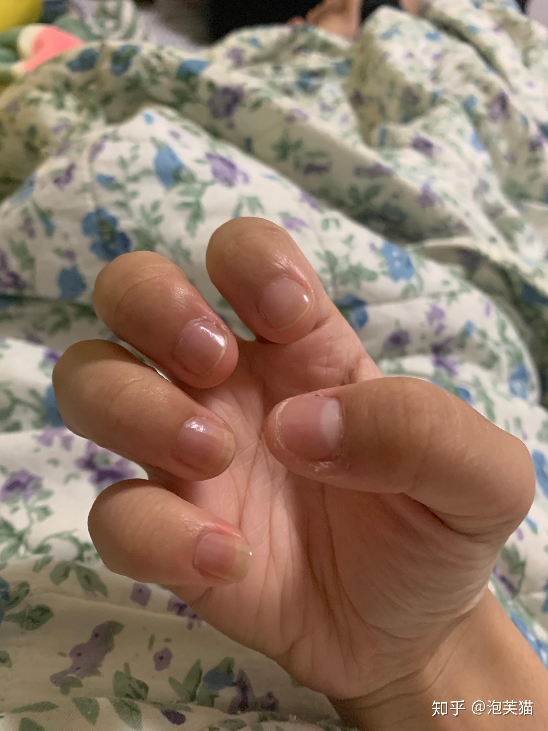 记录养甲床戒咬指甲之路