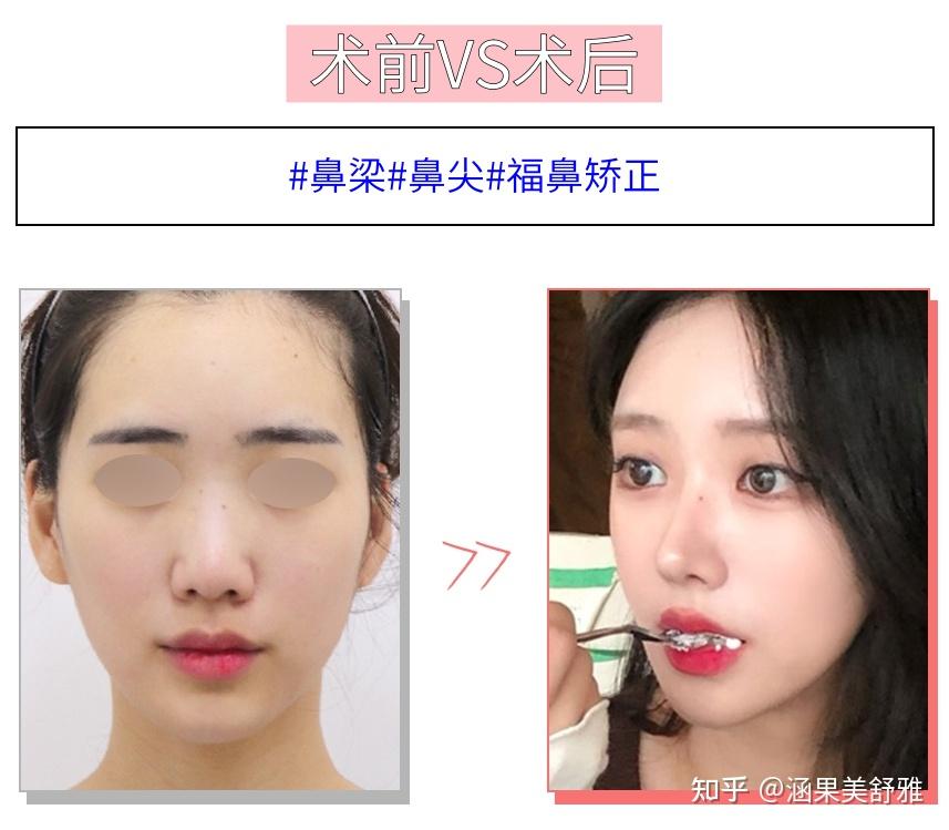 蒜头鼻(福鼻)怎么改善? - 知乎