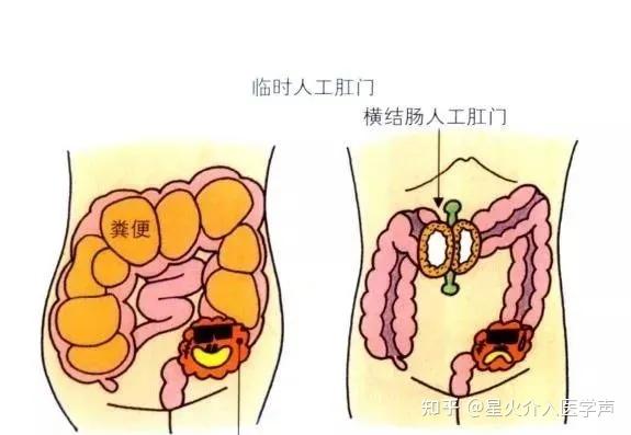 介入医学一出手肠梗阻也要抖一抖