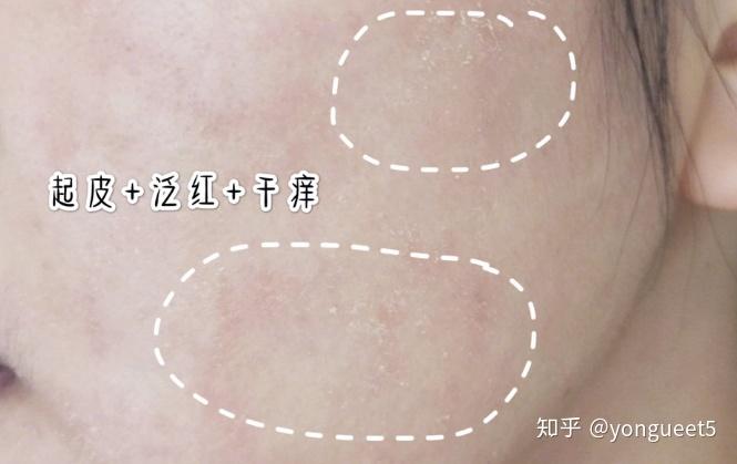 皮肤起皮泛红干痒美丽资产新肌修护精华油快速修复