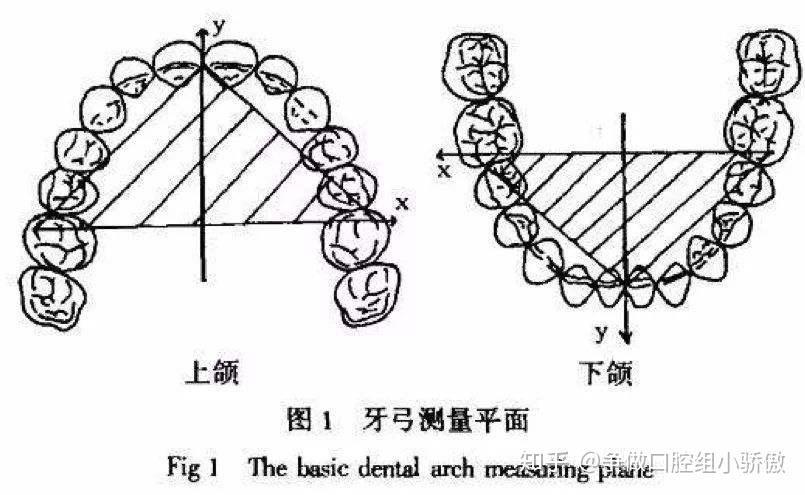 模型上每颗牙最大宽度相加牙冠宽度的总和-牙弓现有弧形的长度=拥挤度