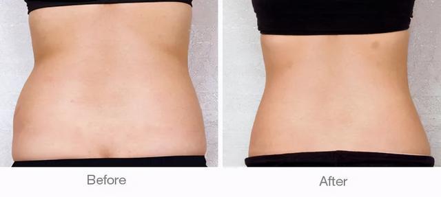 4,生活上避免接触热源腹部抽脂手术后,皮肤可能会常感觉麻木,不易察觉