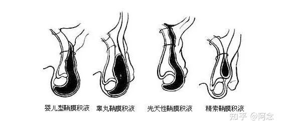 病史如一侧或双侧阴旗内肿块,呈慢性无痛性逐渐增大.
