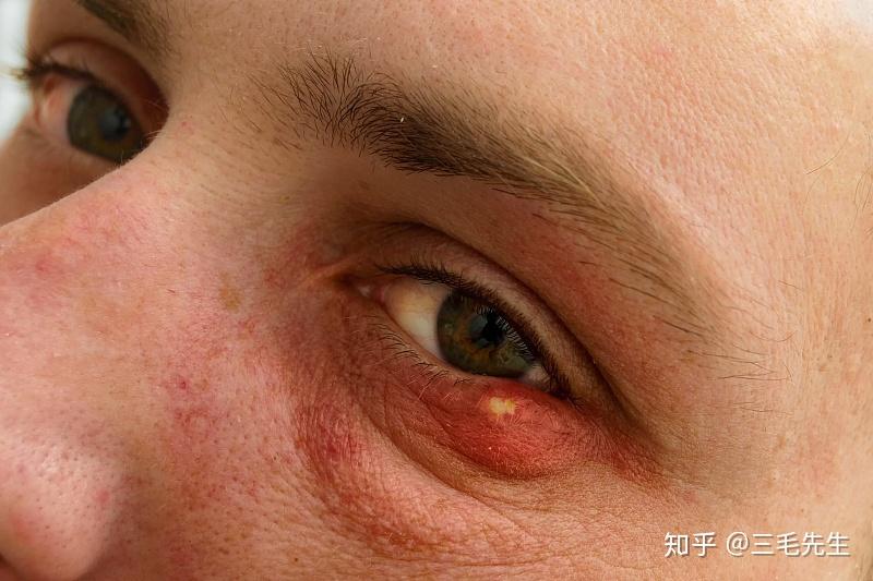 重症肌无力的三个危象