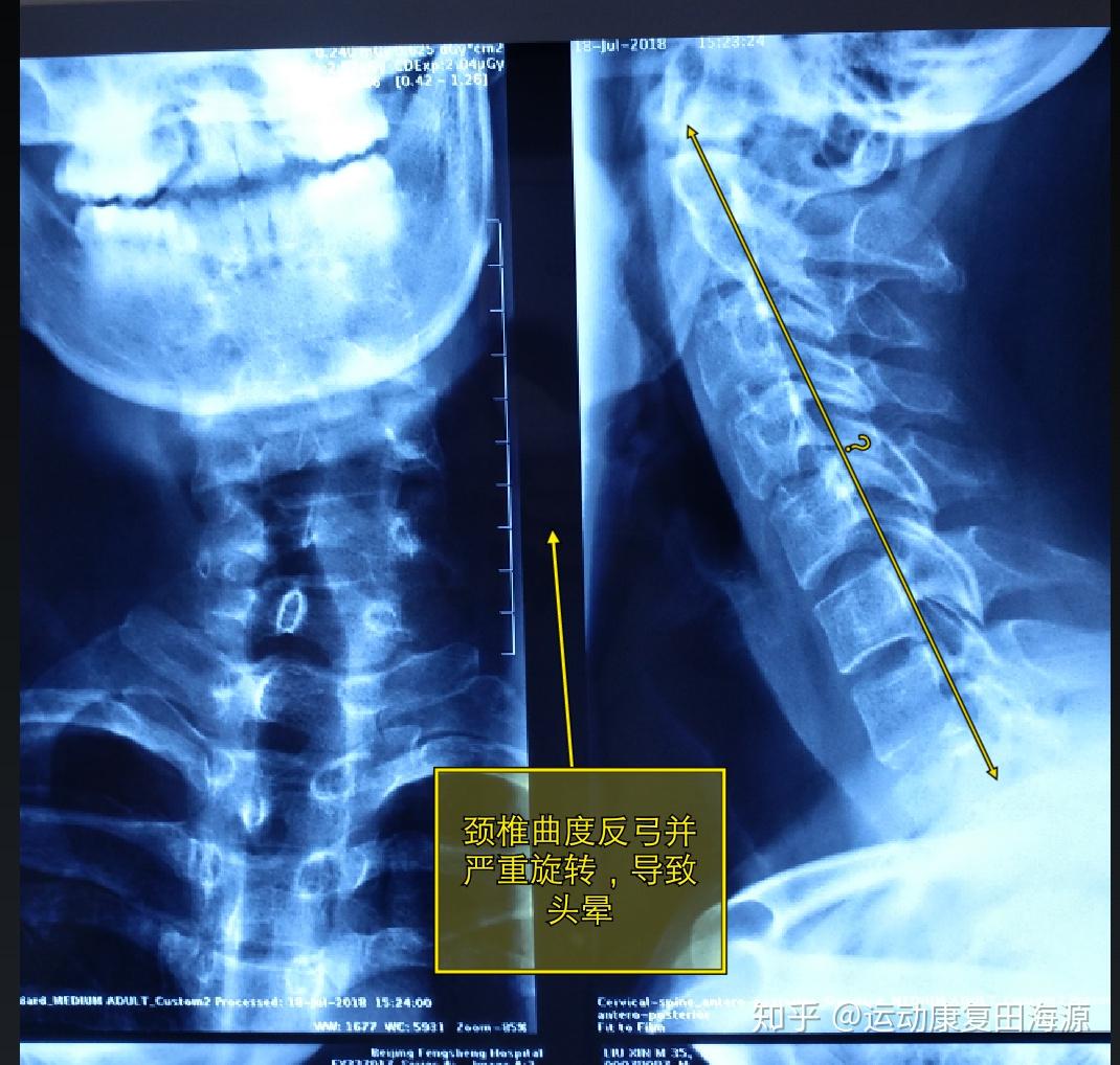 图18-321 椎间孔X线像-口腔颌面及颈部临床解剖学-医学