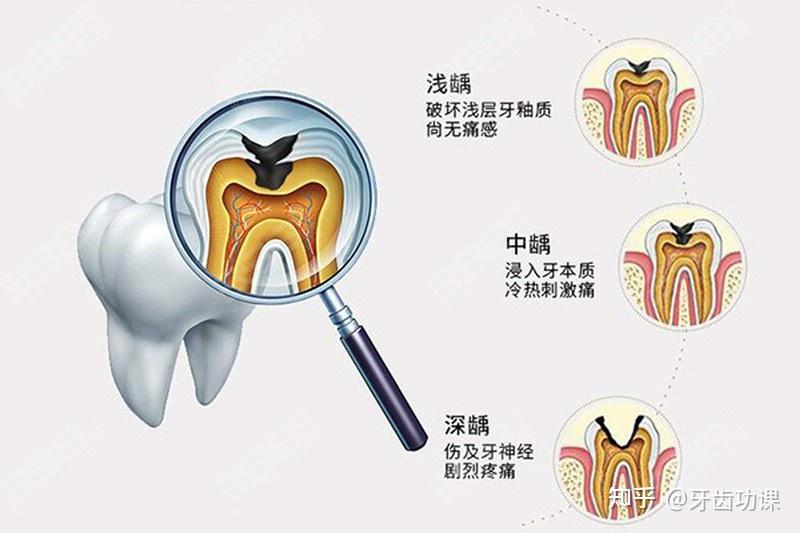 了解完补牙的全过程,其实补牙没那么可怕 - 知乎