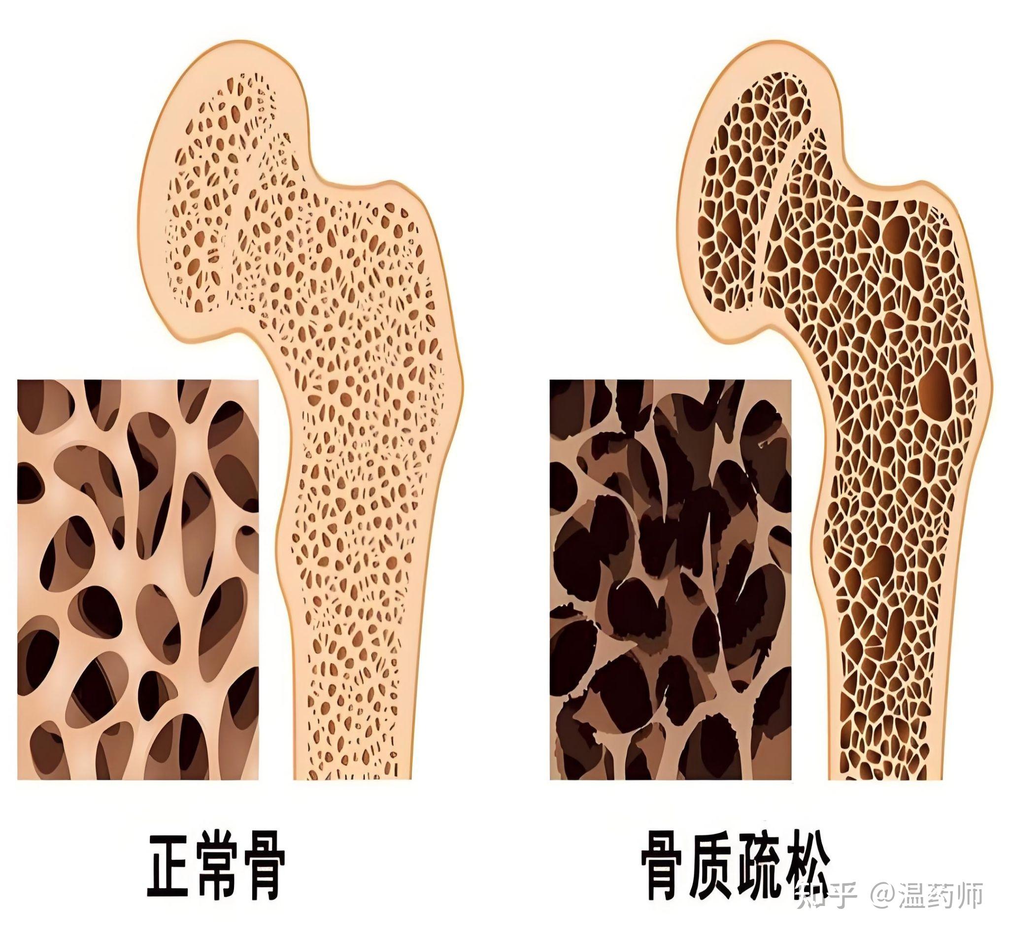 预防骨质疏松5大要点需牢记