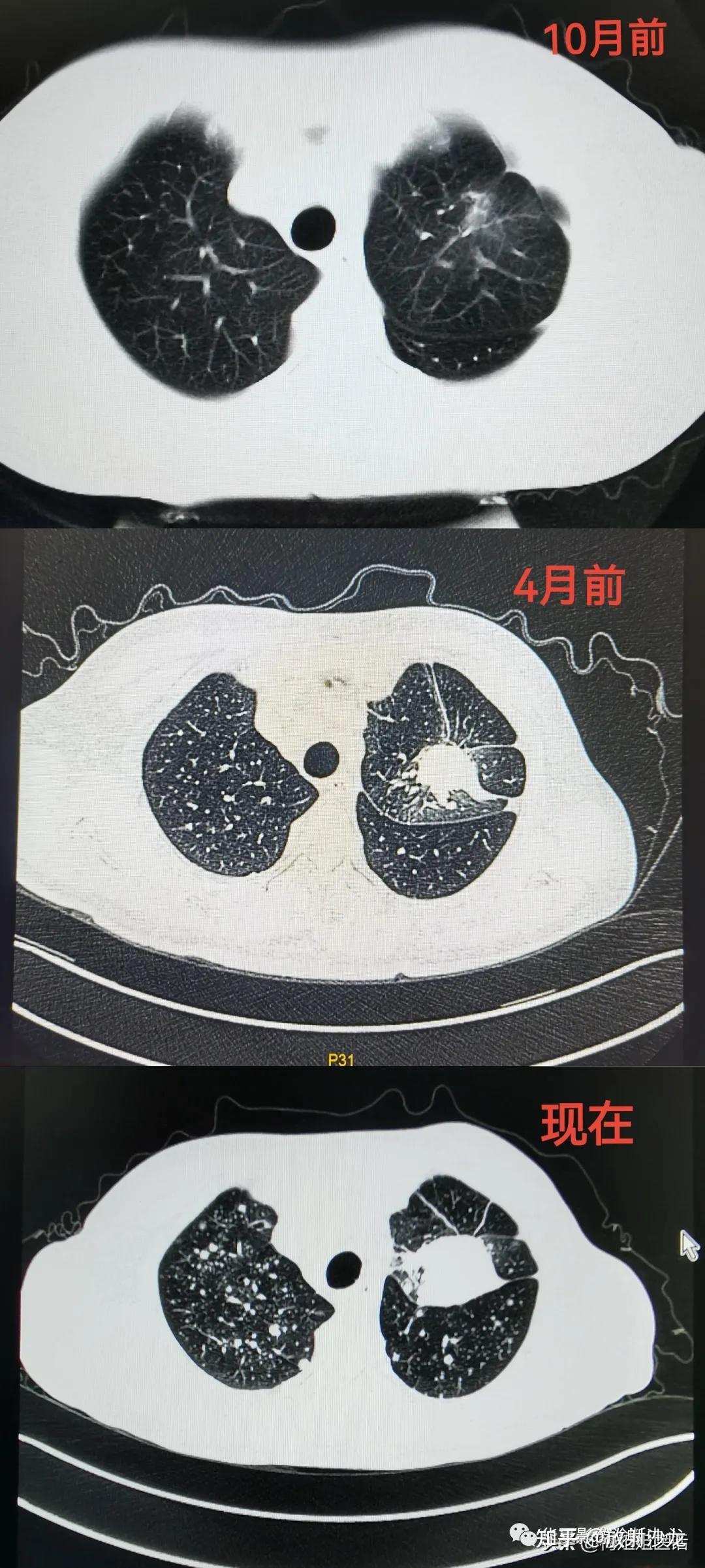 從肺結節到肺癌10個月影像記錄提醒我們正確對待肺結節處理