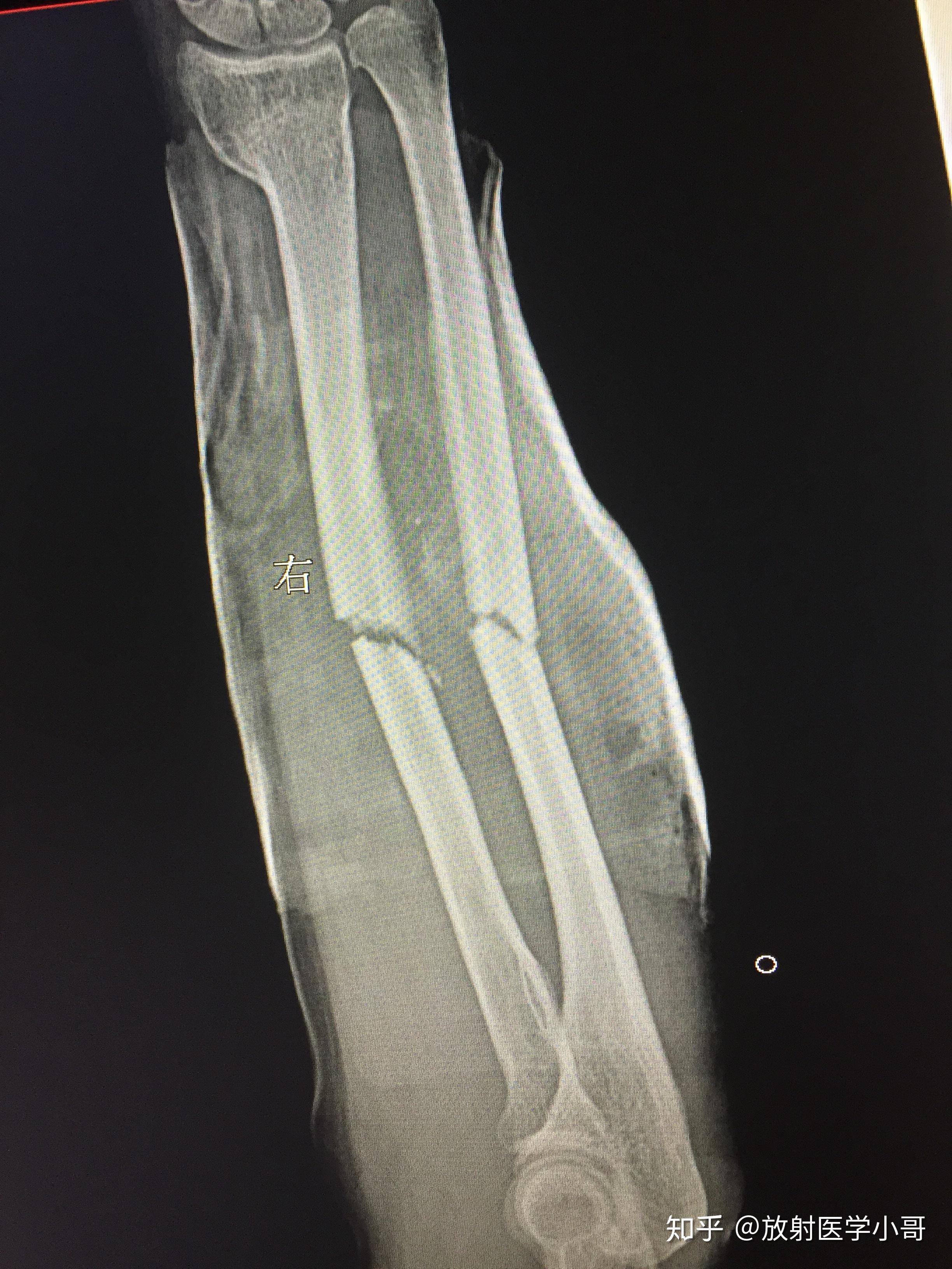 左小腿胫腓骨粉碎性骨折整个历程记录 - 知乎