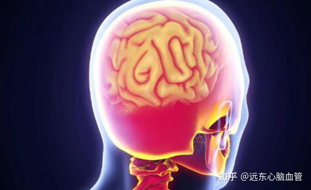 脑血管痉挛的症状 zhuanlan.zhihu.com