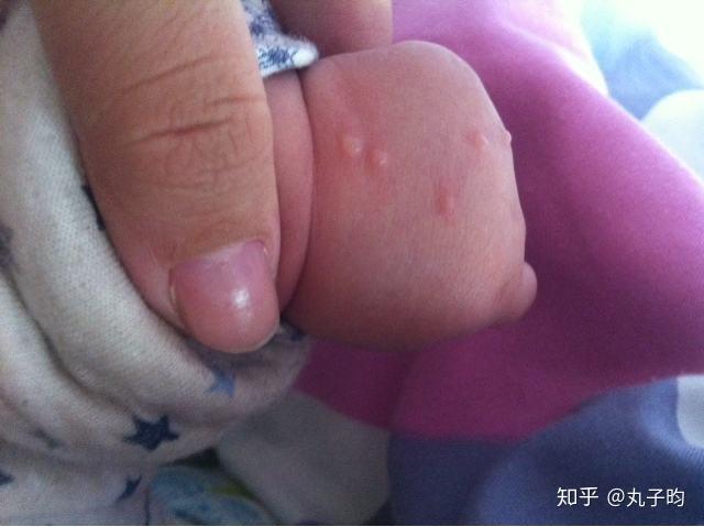 宝宝出水痘怎么办只要宝宝出现任何皮肤上的疾病家长们都要引起足够的
