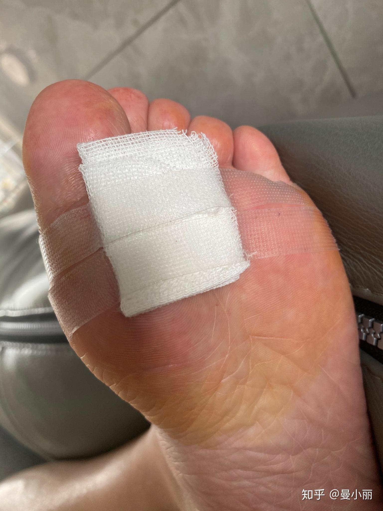 切了个脚底痣皮肤镜呈皮嵴平行模式