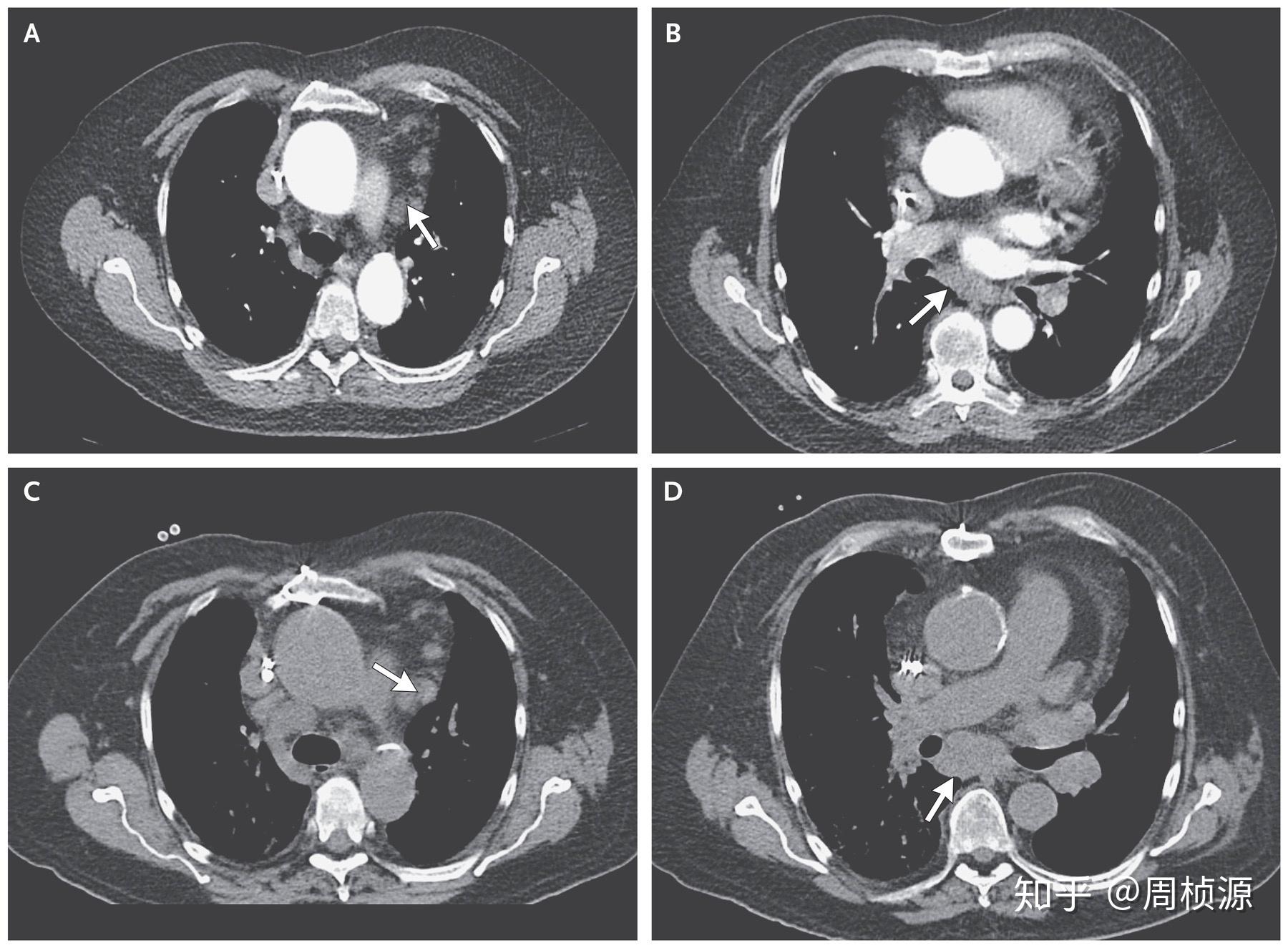 入院检查mpo-anca阳性,血尿蛋白尿,肺门及纵膈淋巴结肿大,肺底片状
