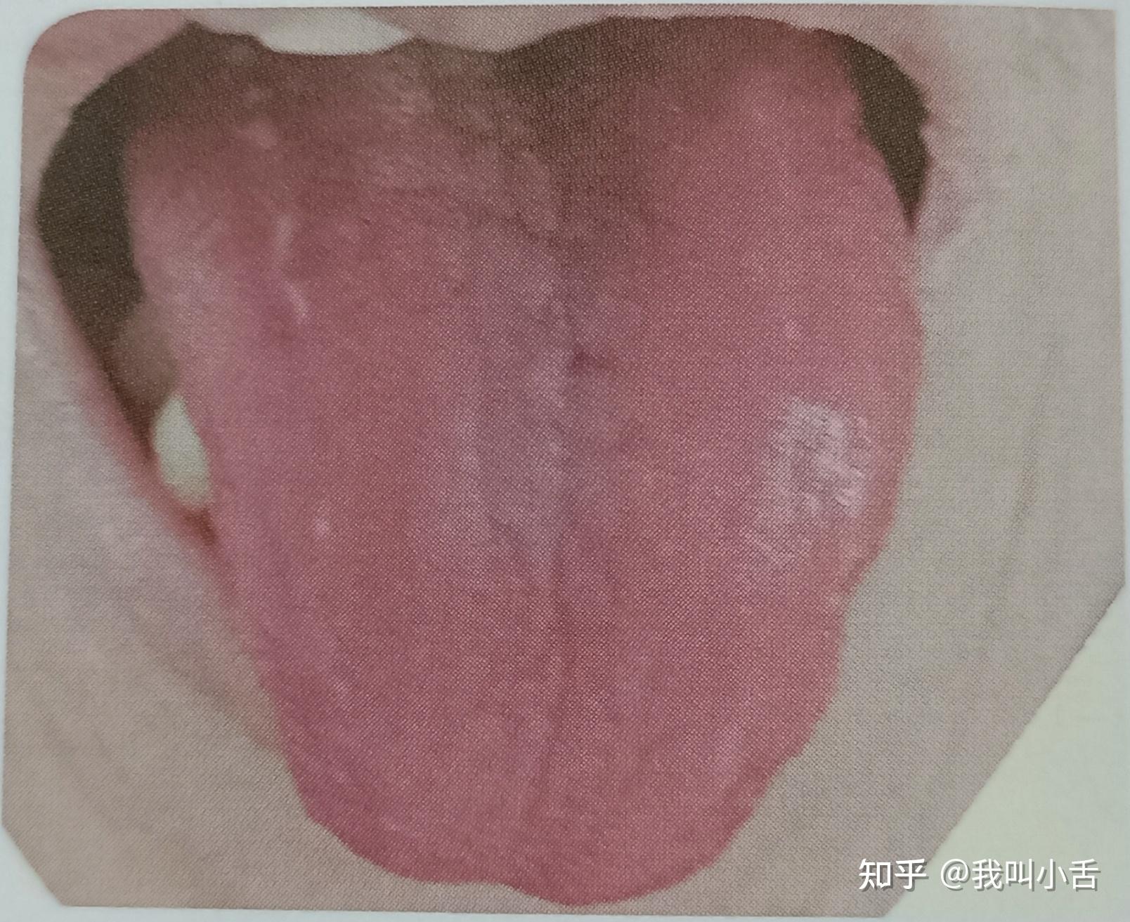 舌癌的早期症状图片 (51)_有来医生