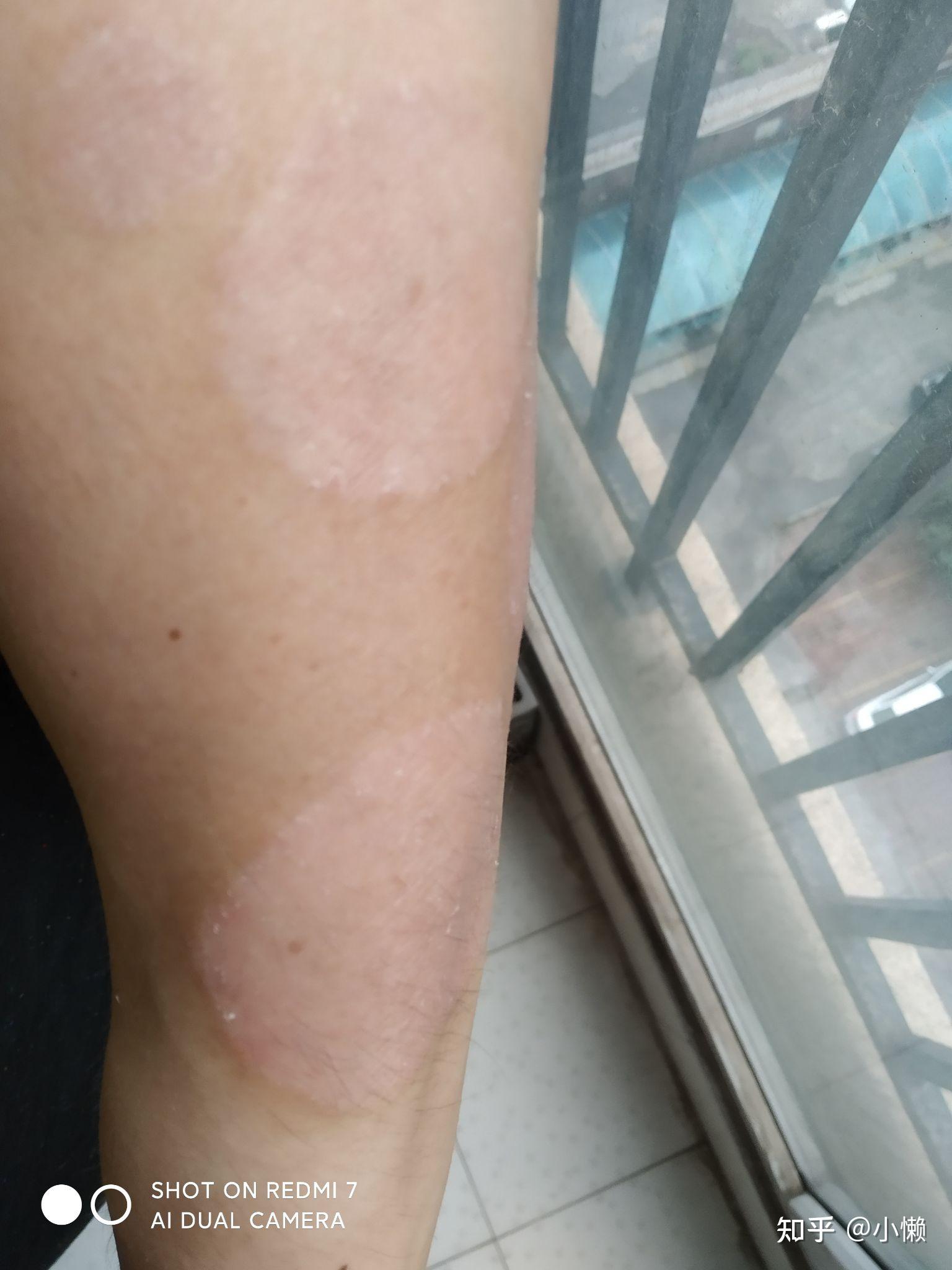 分享可善挺治疗效果,真实记录