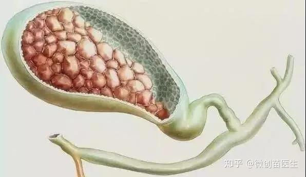 5年生存率不到5 的胆囊癌 你了解多少 知乎