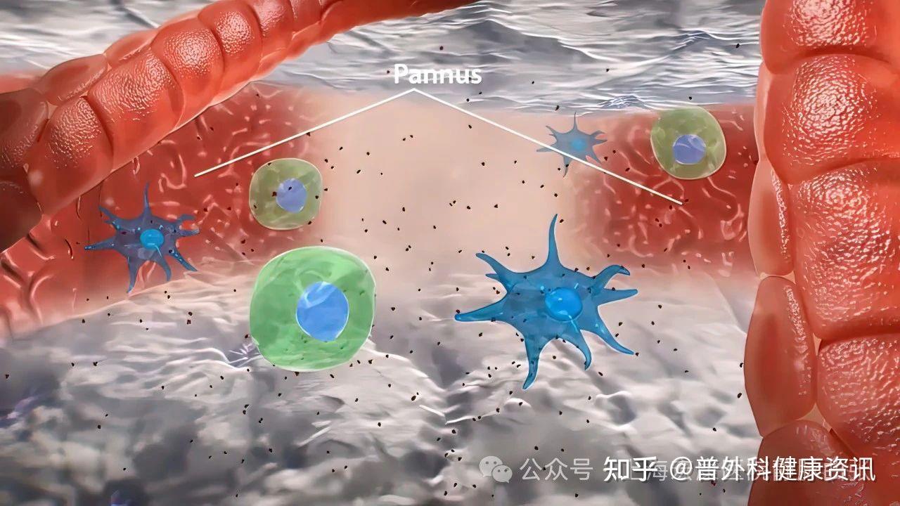 免疫系统的“内战”——血管炎患者必读指南 - 知乎