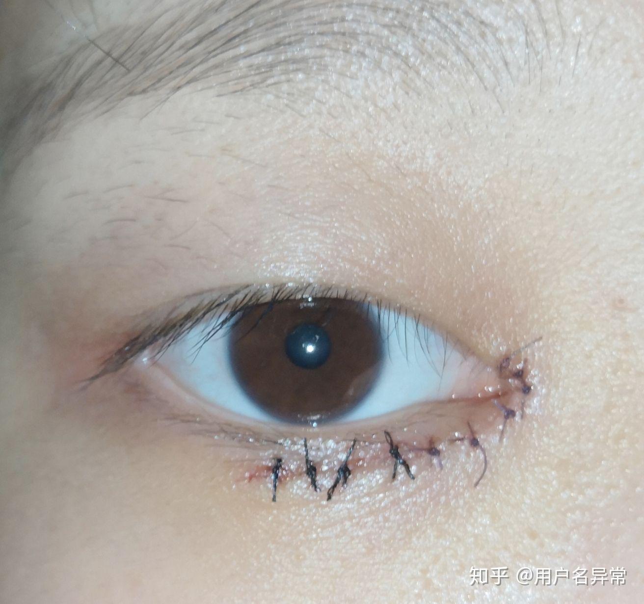 有没有长倒睫的朋友,有做手术的么? - 知乎