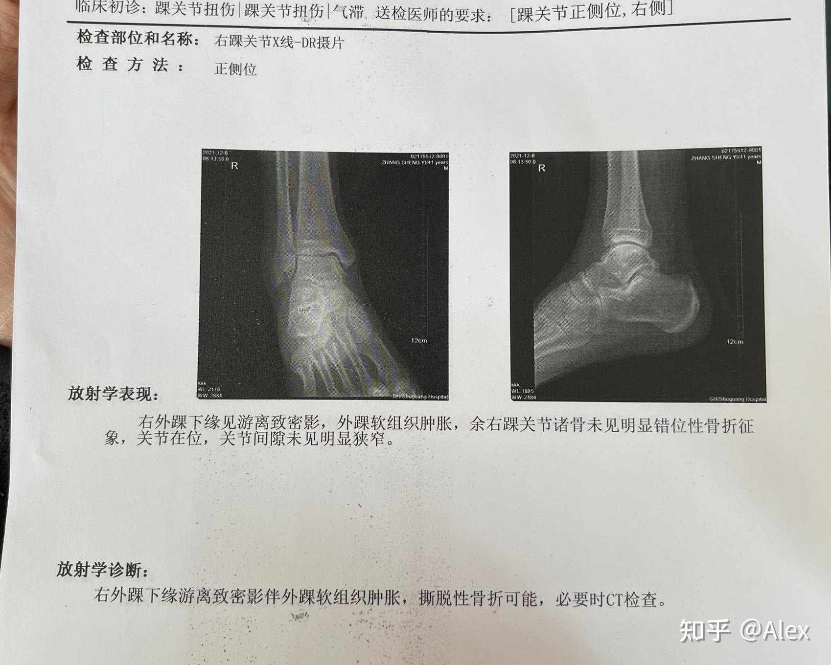 打球被人垫脚,距腓前韧带撕裂加撕脱性骨折恢复全历程慢慢记录