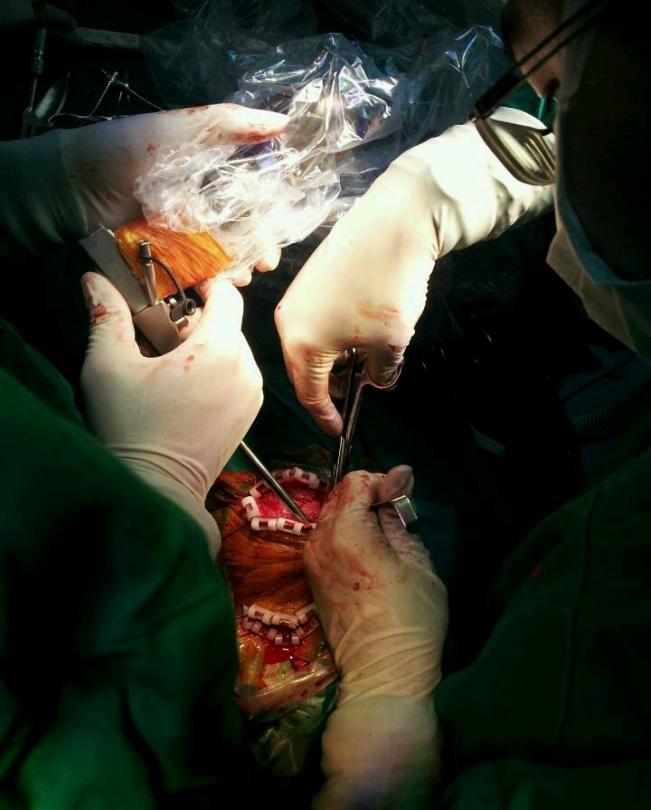 深圳首例内镜辅助下颅缝早闭手术在我院成功完成