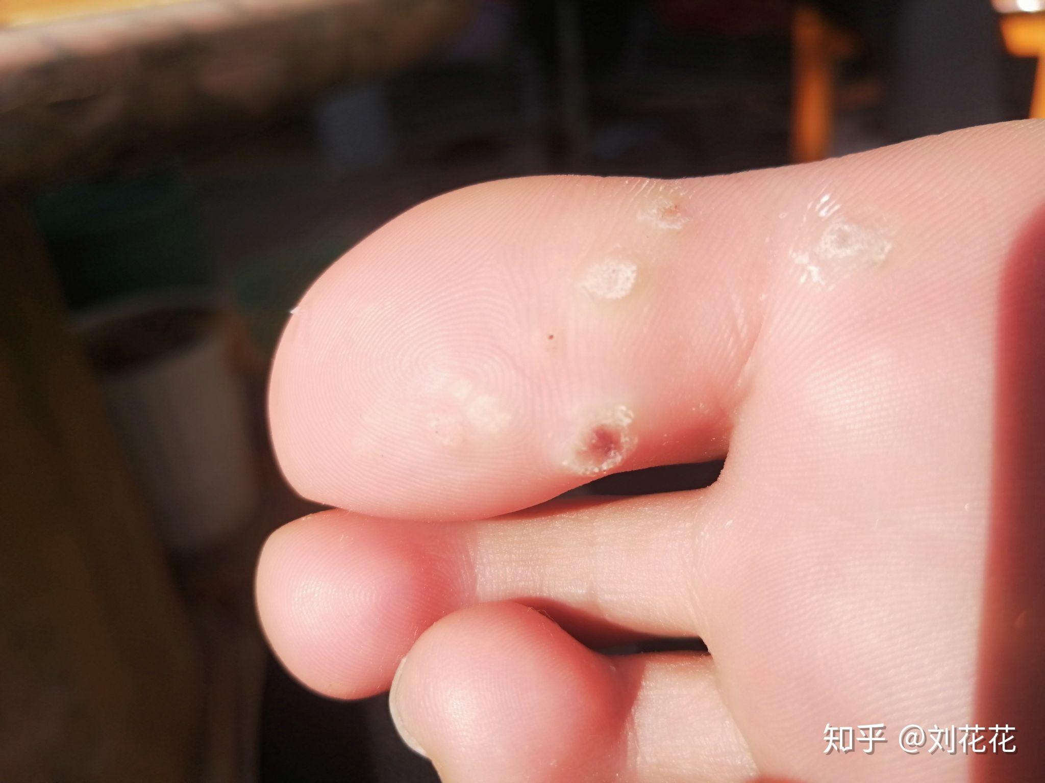 请问这是什么疣怎么治