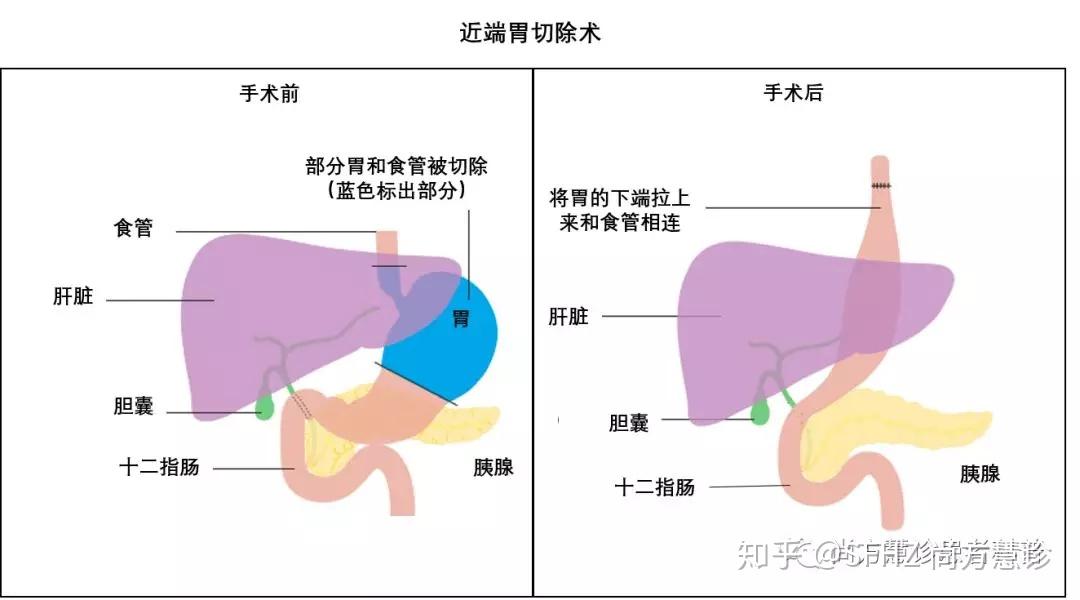 胃癌的手術指征有哪些