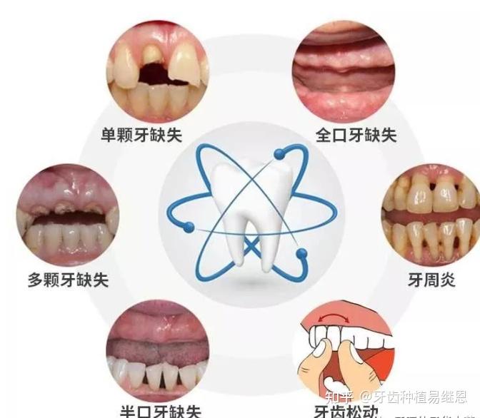 缺牙了就能夠種植嗎種牙可不止需要錢哦