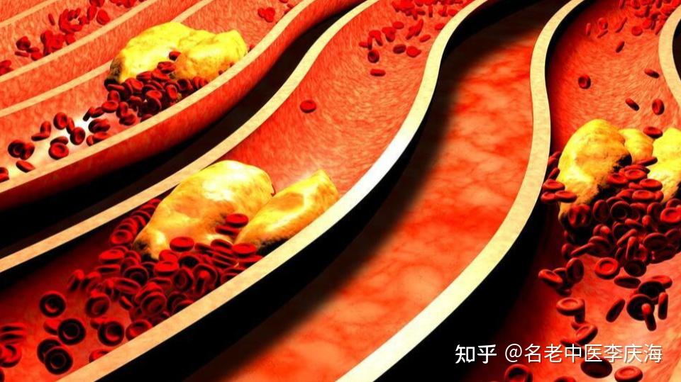 祛痰湿,通气血,中医一个方子,有效清理血管垃圾化解血管堵塞 - 知乎