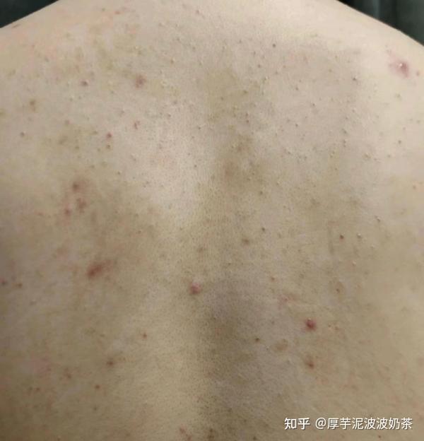 天天洗澡背上还是有痘该怎么办? - 知乎