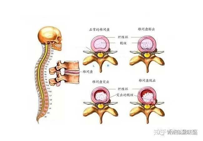 腰痛就是腰突了不好意思腰椎間盤不背這個鍋