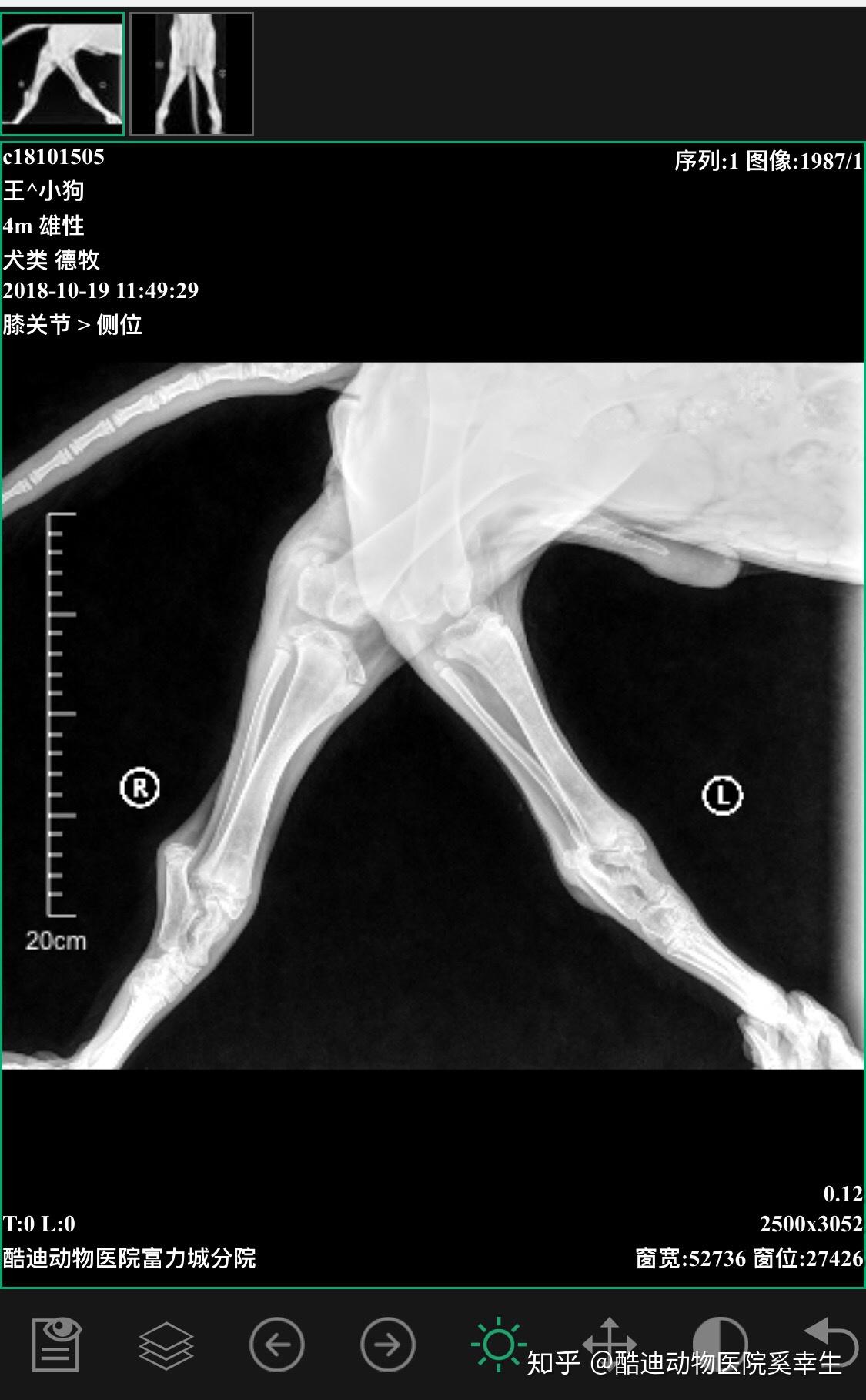 膝关节反屈 - 知乎