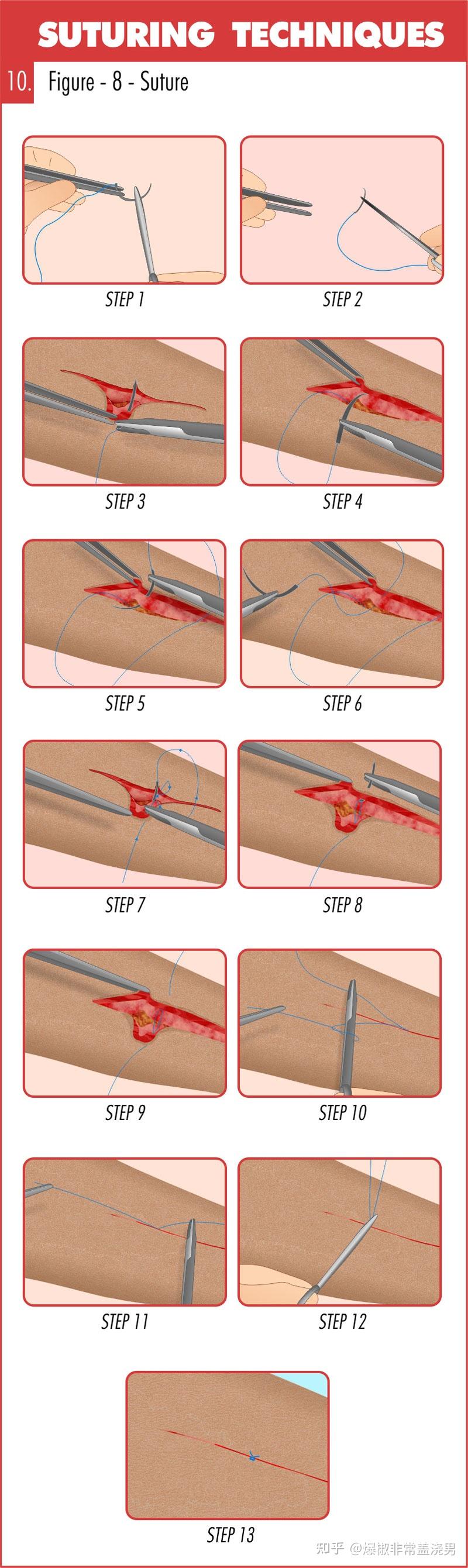 伤口缝合方法图解图片