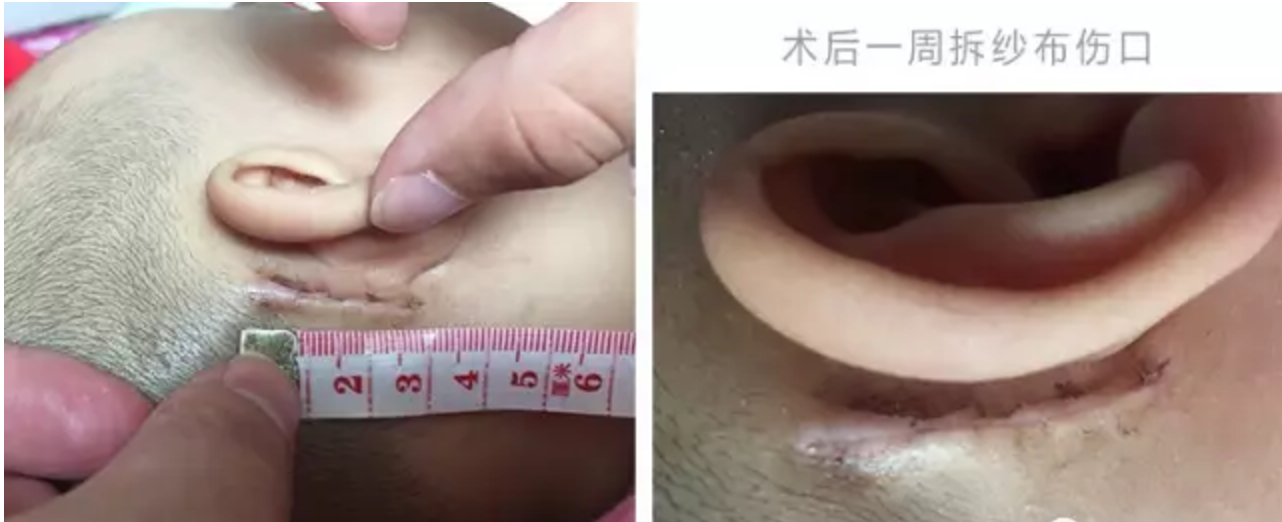 我女儿馨仪的人工耳蜗植入日记