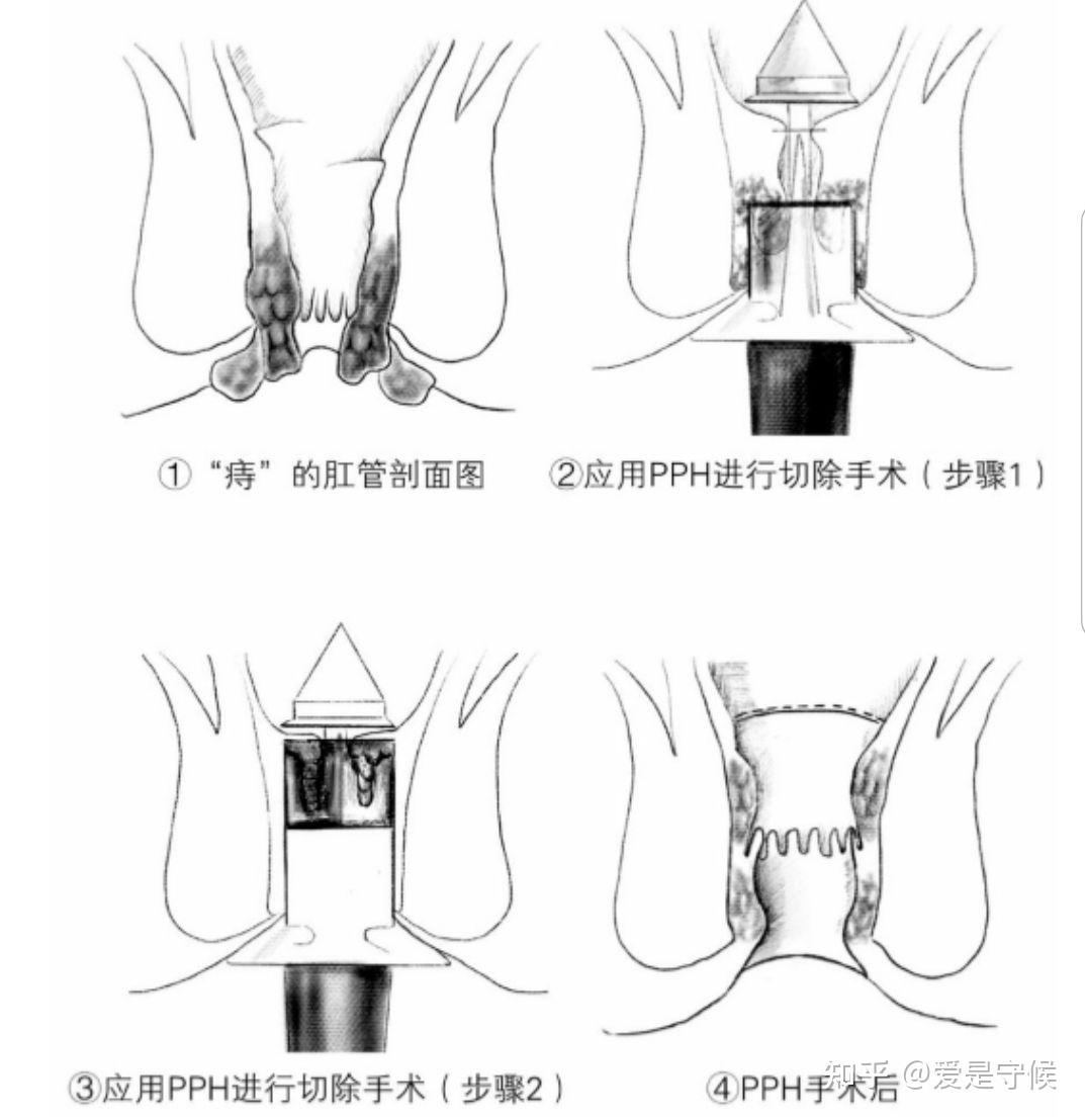 痔疮手术管用吗?其实也不一定断根,看看这儿