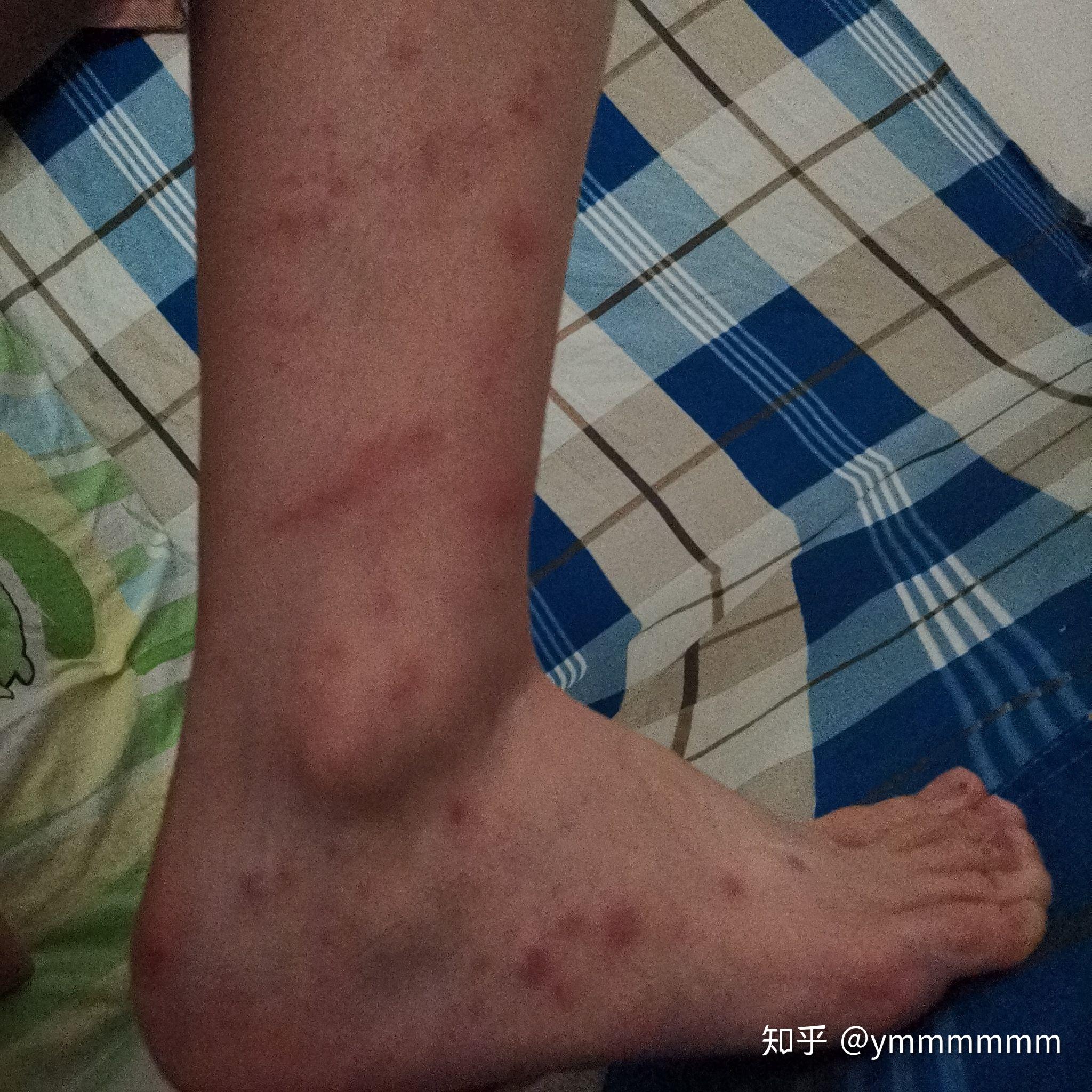 虫咬性荨麻疹一个多月还没好,怎么根治? 