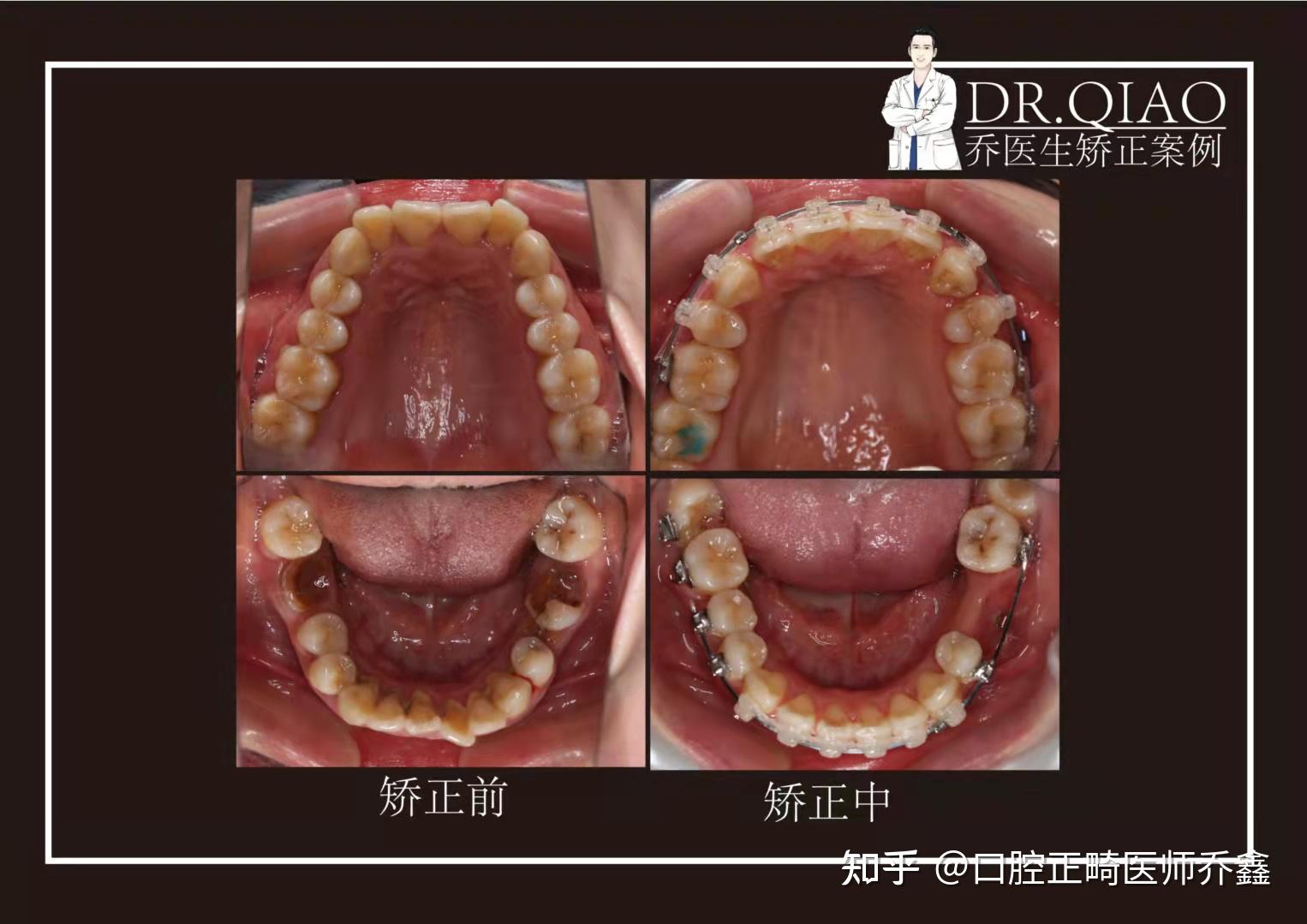 正畸交互牵引示意图图片