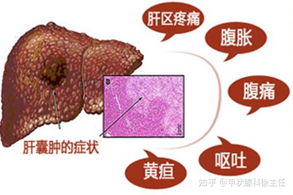 肝囊肿什么科室挂号(肝囊肿什么科室挂号好)