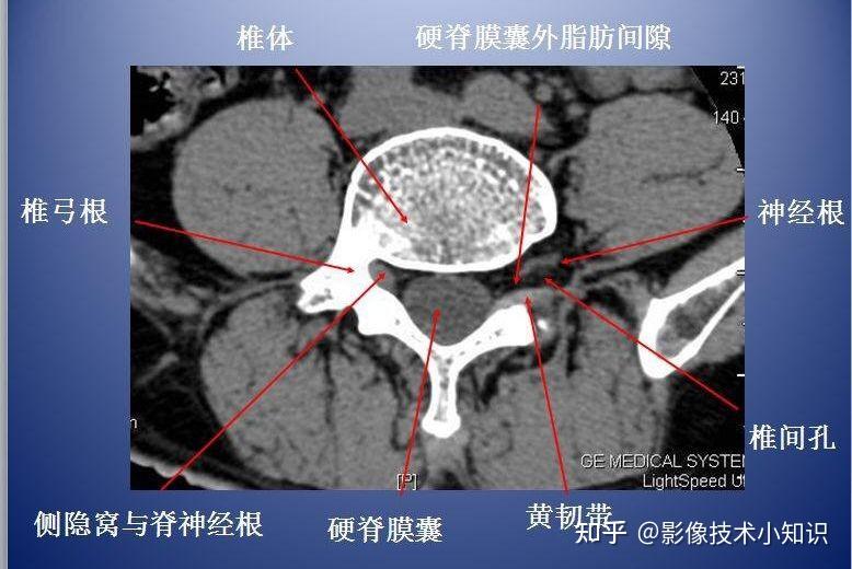 脊柱ct解剖