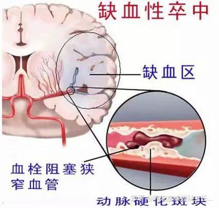 什么是缺血性脑卒中及分型