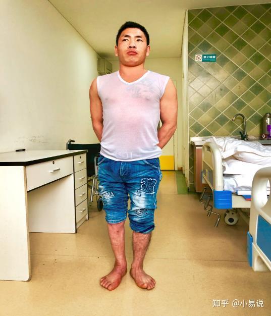 北京尔康百旺医院为云南残疾青年陈浩楠圆走路梦